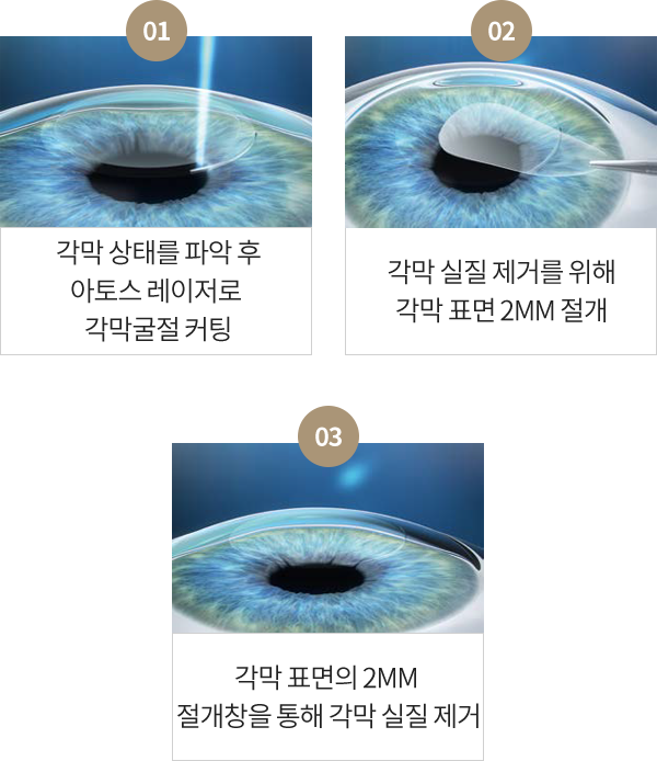 스마트 라식 | 렌즈삽입술하면 하이안과